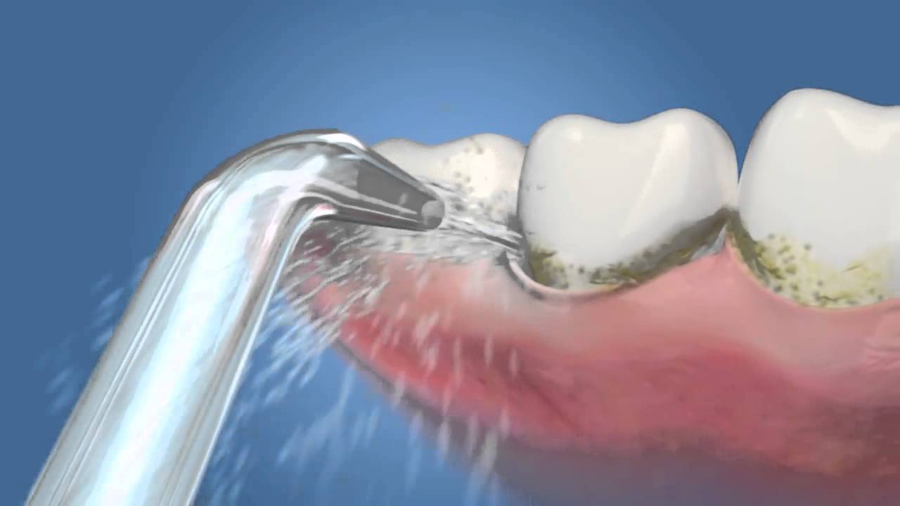 Odstranění zubního plaku ústní sprchou