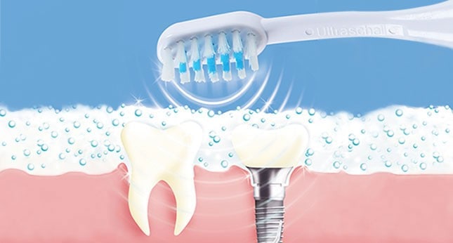 Popis funkce ultrazvukových čističů zubního kamene. Jak funguje ultrazvukový čistič zubů 